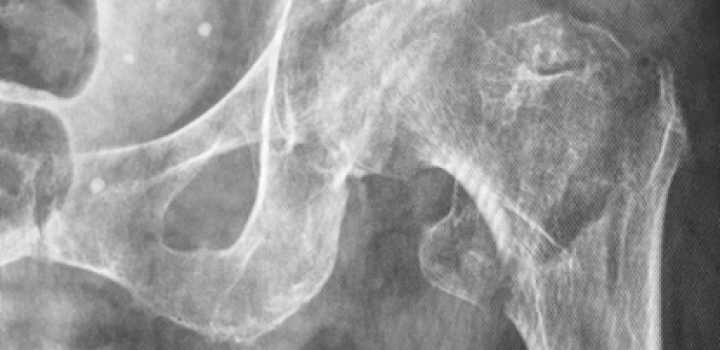 Una fractura por fragilidad ocurre cada tres segundos, urgen medidas de prevención para los huesos: AMMOM Una fractura por fragilidad ocurre cada tres segundos, urgen medidas de prevención para los huesos: AMMOM