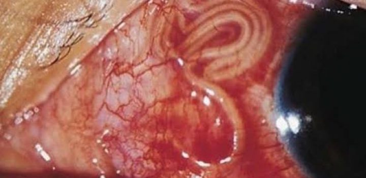 Oncocercosis, historia de una enfermedad erradicada en México Oncocercosis, historia de una enfermedad erradicada en México
