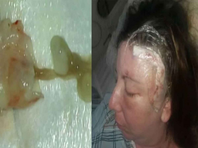 Mujer vive un año con enorme gusano en el cerebro