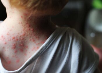 México emite aviso epidemiológico por viruela del mono