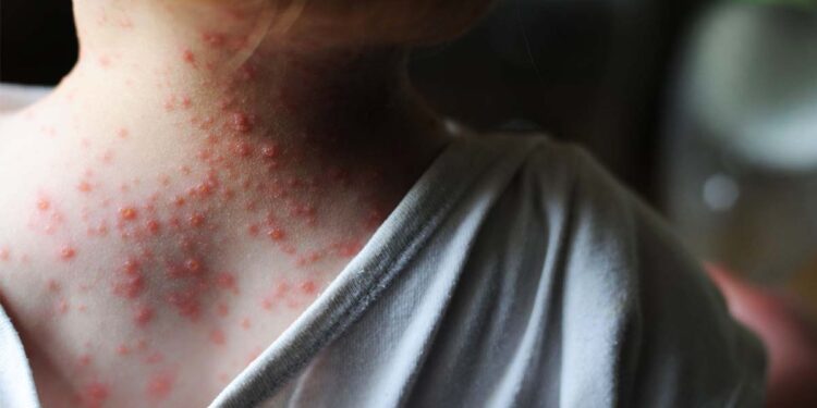 México emite aviso epidemiológico por viruela del mono