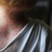 México emite aviso epidemiológico por viruela del mono