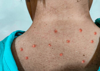 Sube a 60 el número de casos de viruela del mono en México; CDMX y Jalisco son los estados con más contagios