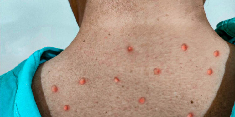 Sube a 60 el número de casos de viruela del mono en México; CDMX y Jalisco son los estados con más contagios