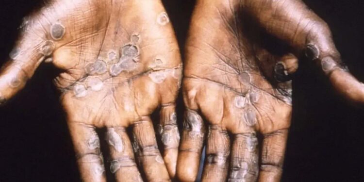 México confirma 55 casos de viruela del mono