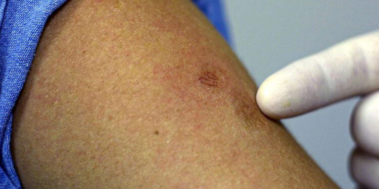 México reporta 91 casos confirmados de viruela del mono