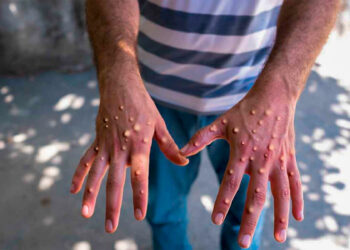 Incrementan a 252 los casos confirmados de viruela del mono en México