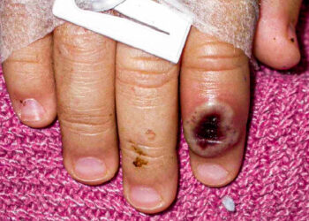 Sube a 386 el número de casos confirmados de viruela del mono en México