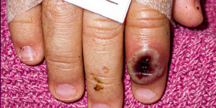 Sube a 386 el número de casos confirmados de viruela del mono en México