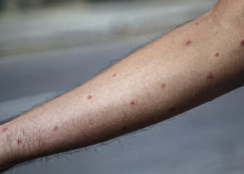 Maestro de Coahuila enferma de viruela del mono