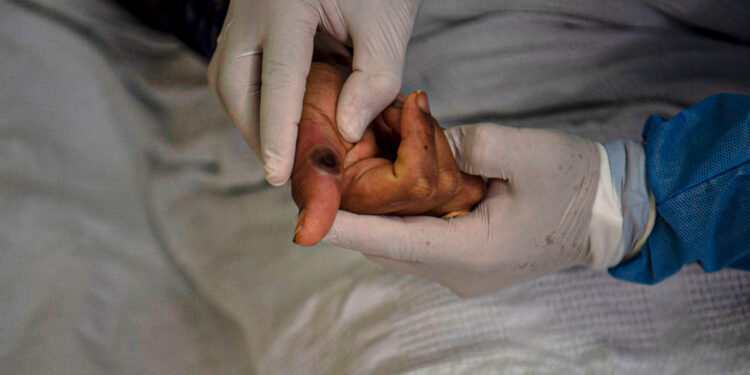 ¡Ay no! México rebasa los mil casos confirmados de viruela del mono