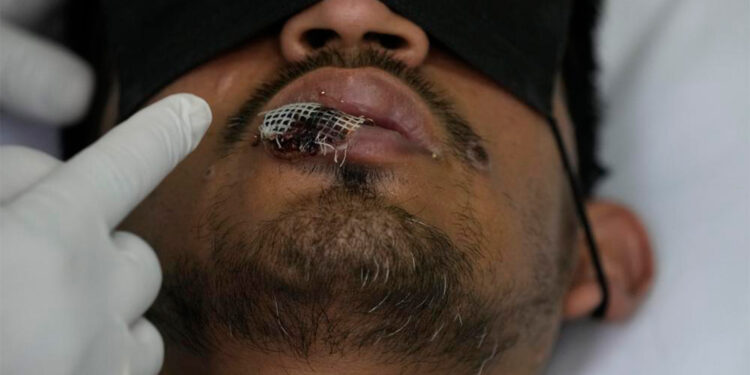 América es el epicentro del brote de la viruela del mono en el mundo: OPS