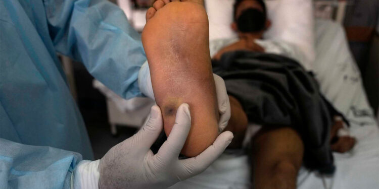 México reporta 2,147 casos confirmados de viruela del mono