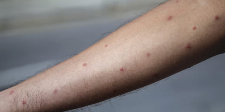 Viruela del mono: Hay mil 968 casos confirmados en México