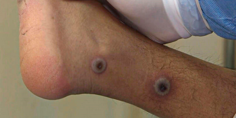 México rebasa los 3 mil casos confirmados de viruela del mono