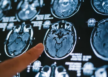 Científicos mexicanos desarrollan biomarcadores para detectar Alzheimer con IA