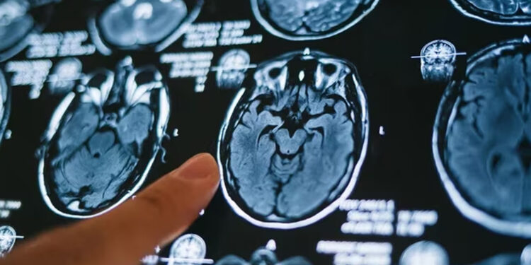 Científicos mexicanos desarrollan biomarcadores para detectar Alzheimer con IA