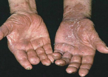 Secretaría de Salud reporta 300 casos de lepra en 28 estados