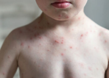 Muertes por sarampión en todo el mundo aumentaron más del 40% en 2022