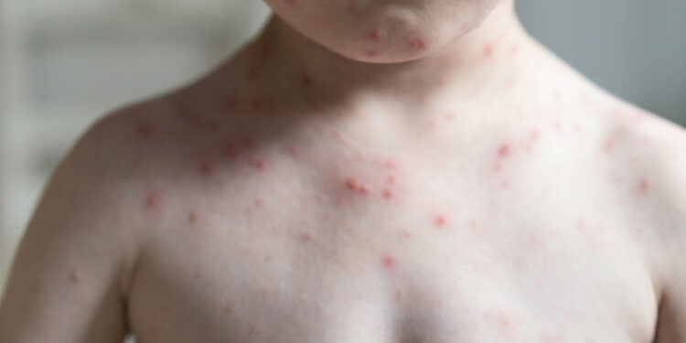 Muertes por sarampión en todo el mundo aumentaron más del 40% en 2022