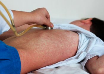 Alerta UNAM por resurgimiento de sarampión en México