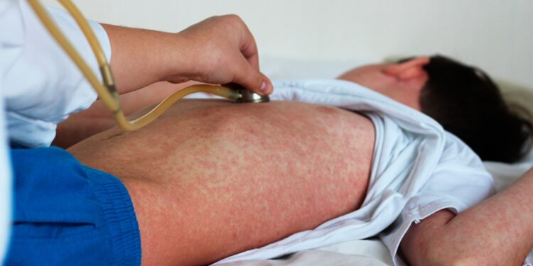 Alerta UNAM por resurgimiento de sarampión en México